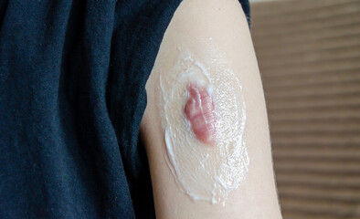 Applying cream to remove scar. keloid scar on shoulder of woman. Removal of formations on skin.