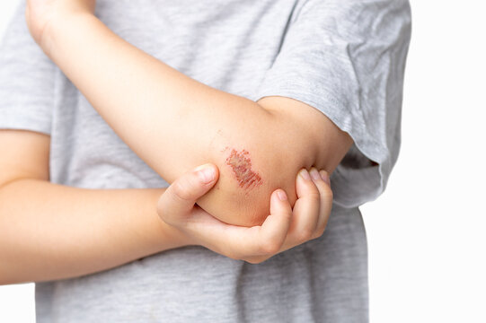 Children injury. Deep scratches on the skin of the children's elbow hand. Wounds, scratches, abrasions on the child's arm on a white background