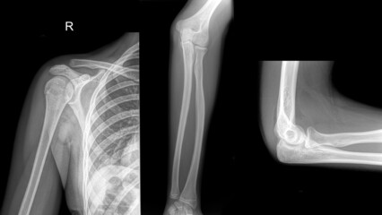 X ray of a arm, forearm and elbow.