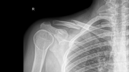 X-ray of a right  clavicle fracture - obrazy, fototapety, plakaty