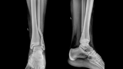 fibula fracture of a young football player patient. - obrazy, fototapety, plakaty