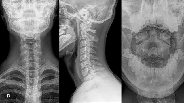 cervical spine of a patient in different projection..