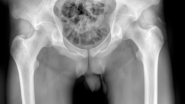 radiography of a normal adult pelvis bones.