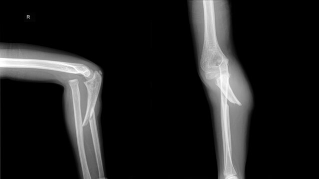 X ray  ulnar fracture and radial dislocation of a child patient.
