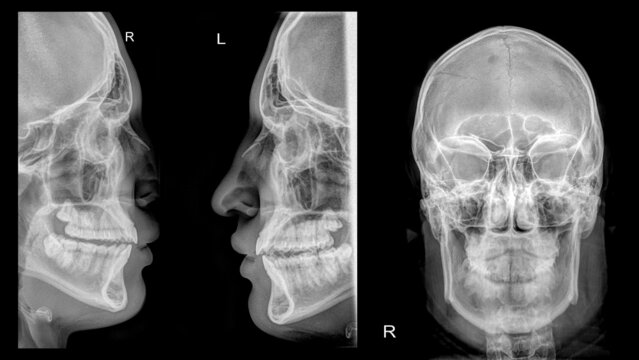 adult victim patient with broken nasal bones and right parietal bone fracture..