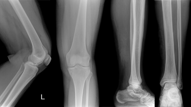 leg and Knee x-ray film of an adult patient.