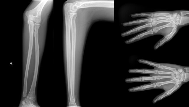 X-ray of forearm, hand and fingers..