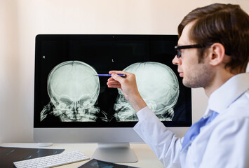 Man radiologist analyzing a child skull x ray with left parietal bone fracture.