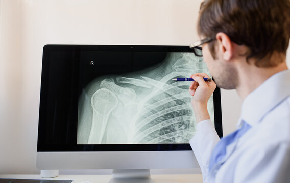 radiologist analyzing a patient x ray with a clavicle fracture.