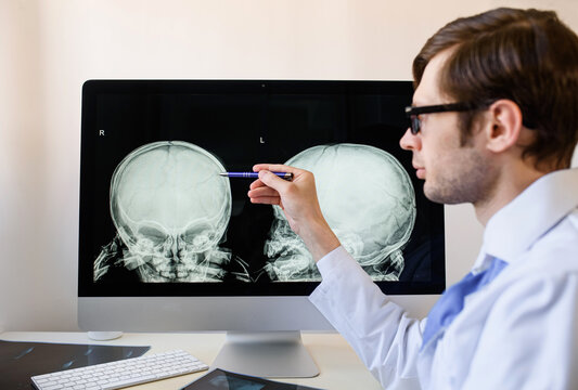 Man Radiologist Analyzing A Child Skull X Ray With Left Parietal Bone Fracture.