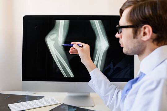 radiologist analyzing a patient child elbow bones x ray with a distal humerus fracture with displacement.
