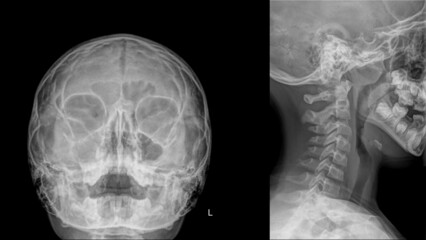 Paranasal sinus x-ray of a child with chronic sinusitis and adenoid vegetation..