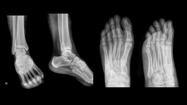 adult foot and ankle x-ray film.