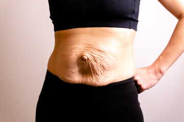 cropped woman dressed in black top and black leggings. Diastasis and umbilical hernia after...