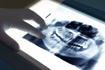 Close-up of a dental x-ray, doctor's hand pointing to an infected tooth