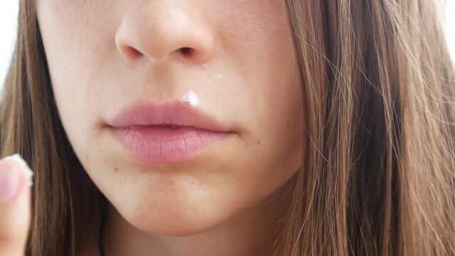 A young lady smears herpes on her lip with salve close-up