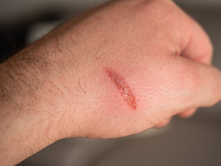 Fototapeta premium Male hand with burn wound (combustio) caused by a hot oven tray. 