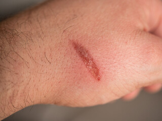Male hand with burn wound (combustio) caused by a hot oven tray. 
