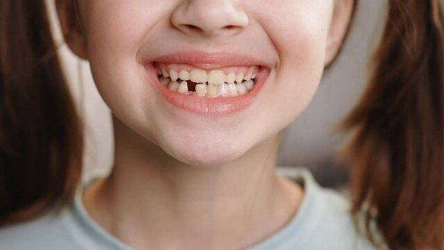 Close-up smile face of a child girl. A beautiful little girl 7-8 years old has lost milk teeth. Loss of milk teeth, replacement of permanent teeth. Children is dentistry
