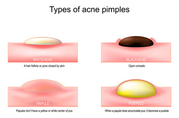 Types of acne pimples
