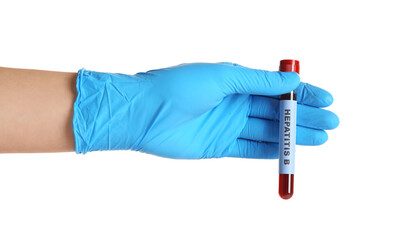Obraz premium Scientist holding tube with blood sample and label Hepatitis B on white background, closeup