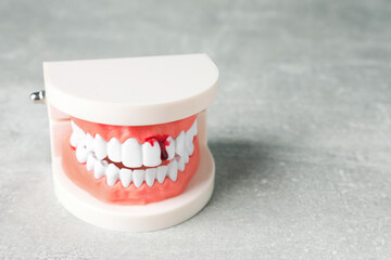 Model of jaw with blood on light grey table, space for text. Gum inflammation