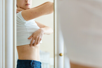 Woman looks to an itching rash on dry flaky irritatng skin of psoriasis or eczema - obrazy, fototapety, plakaty