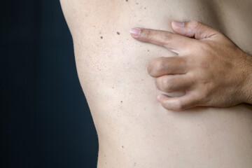 Closed up of Skin Tags or Acrochordon under the armpit