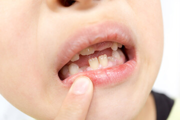 日本人の子供の抜け落ちた乳歯