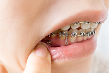 日本人女性の歯科矯正イメージ