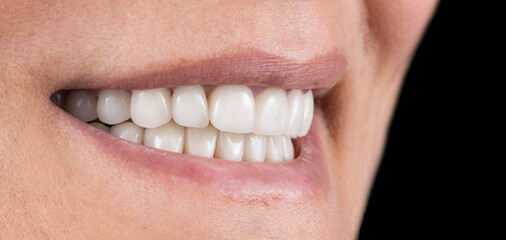 ceramic teeth with natural look and shape