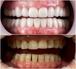 crowns and venners b1 color