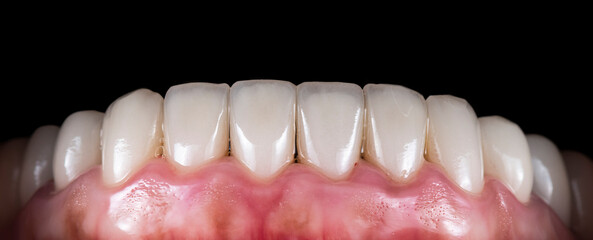 crowns and venners b1 color