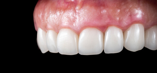 crowns and venners b1 color