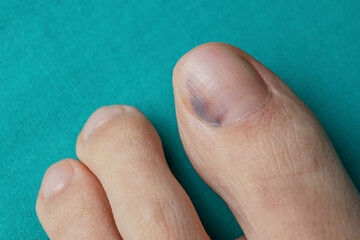Nail bruise on green background. Medicine concept