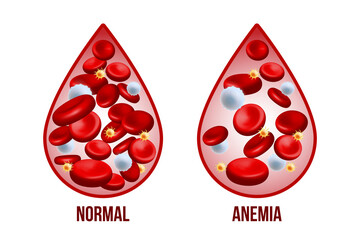 Iron deficiency anemia.The difference of Anemia amount of red blood cell and normal. - 494743123