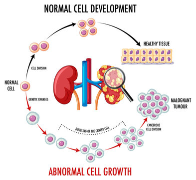 Diagram showing normal and cancer cell