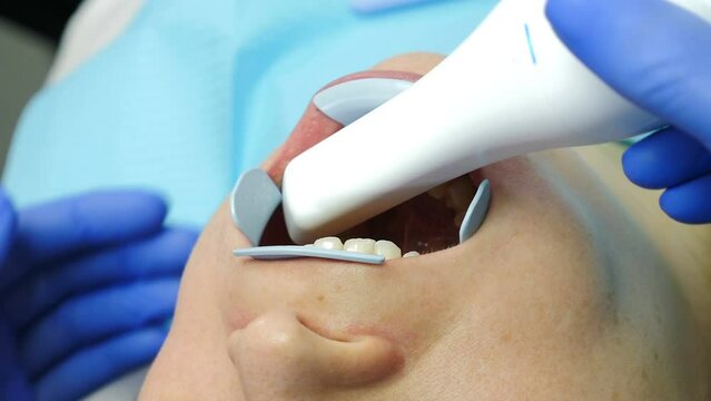 Modern dental clinic concept. Orthodontist using 3D intraoral scanner for scanning patient teeth. Close up. Manual teeth scanner. New technologies in dentistry. Healthcare And Stomatology. 4 k video
