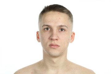 Obraz premium Young man with problem face skin isolated on white background