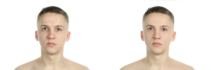 Obraz premium Before and after effect of skin care procedures, isolated on white background