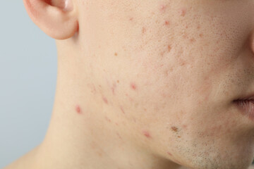 Concept of skin care with problem skin, close up