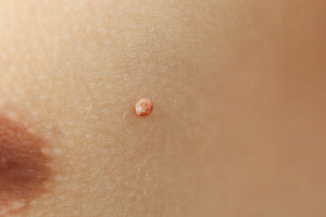 Concept of body care with skin with papilloma or mole