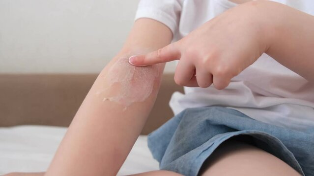 The child scratches atopic skin. The child applies a special cream to atopic skin. Dermatitis, diathesis, allergy on the child's body. 