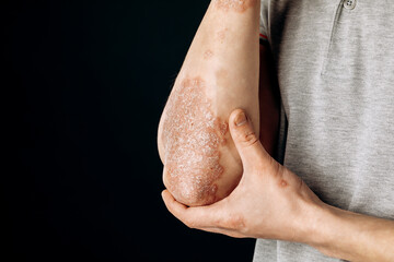 Naklejka premium Acute psoriasis on the elbows is an autoimmune incurable dermatological skin disease. A large red, inflamed, flaky rash on the elbows. Joints affected by psoriatic arthritis