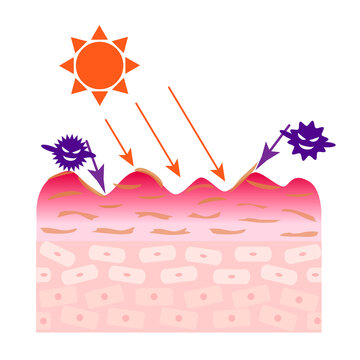 肌荒れの断面図。紫外線でシミができるイメージ図。