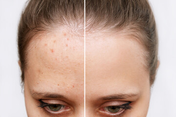 Fototapeta premium Cropped shot of a young woman's face before and after acne treatment on face. Pimples, red rash on the forehead of the girl. Problem skin, allergy, care and beauty concept. Dermatology, cosmetology