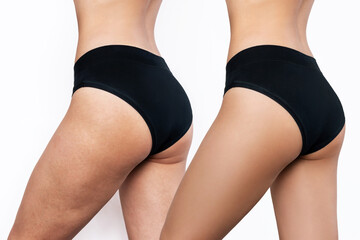 Young woman's thighs with cellulite before and after treatment. Getting rid of excess weight....