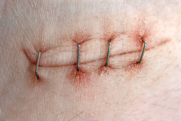 Surgical staples for sutures to close skin. First aid for a deep cut on the skin. Antiseptic and...