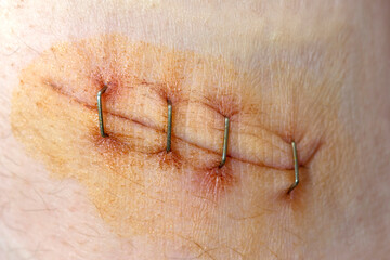 Surgical staples for sutures to close skin. First aid for a deep cut on the skin. Antiseptic and...