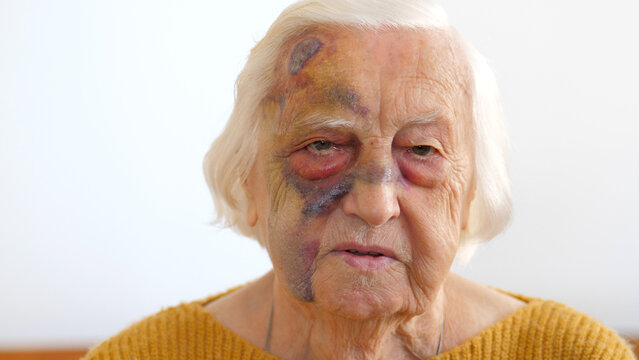 Old Woman With Bruises On The Face. Bruises Caused By Dizziness, Falling Over And Hitting With Head On The Floor. Blood From The Head Area Moved To The Eye And To The Face